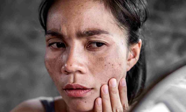 How to Remove Dark Spots on the Face